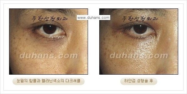 [두한성형외과 경쟁력 눈성형] - [젊은 눈매로의 복원 안검성형] 관련 이미지 35