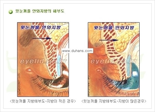 [두한성형외과 경쟁력 눈성형] - [지방제거 안내] 관련 이미지 2