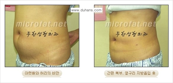 [두한성형외과 겨울엔 지방흡입] - [간편한 복부지방흡입 도전 2.] 관련 이미지 3