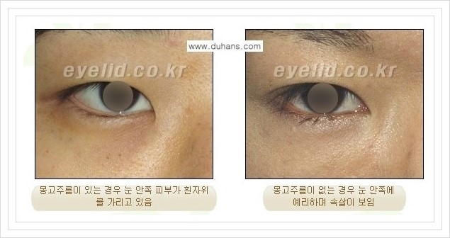 [두한성형외과 경쟁력 눈성형] - [흉터없는 몽고주름 제거 - 앞트임 수술 안내] 관련 이미지 2