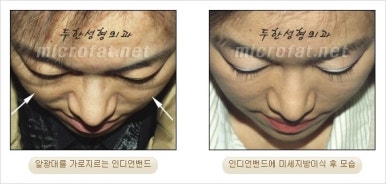 [Facial Autologous Fat Grafting, Duhan Plastic Surgery] - [Indian Wrinkle] image 12