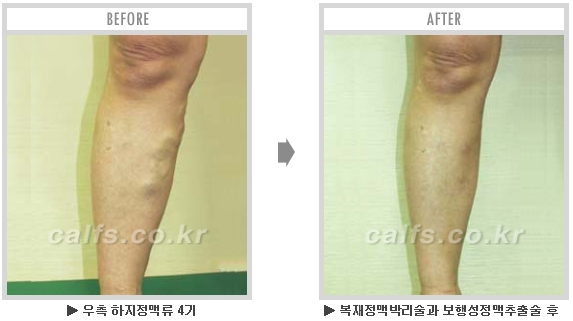 [종아리성형 두한성형외과] - [종아리수술에 대한 자주하는 질문과 답변 모음] 관련 이미지 14
