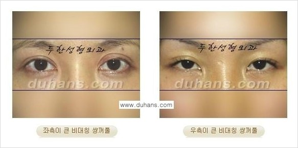 [두한성형외과 경쟁력 쌍꺼풀 재수술, 극한 재수술] - [비대칭(짝짝이) 쌍꺼풀 라인 교정 안내] 관련 이미지 2