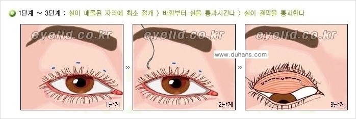 [두한성형외과 경쟁력 눈성형] - [절개법, 매몰법의 수술 방법] 관련 이미지 7