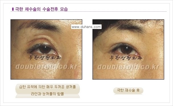 [두한성형외과 경쟁력 쌍꺼풀 재수술] - [극한의 상태에서 쌍꺼풀 재수술 안내 ①] 관련 이미지 4