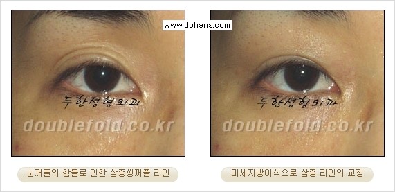 [두한성형외과 경쟁력 눈성형] - [삼중(세겹) 쌍꺼풀 라인의 교정] 관련 이미지 16