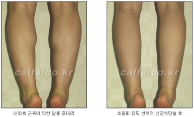 ​[두한성형외과 종아리수술] - [나에게 맞는 종아리성형방법] 관련 이미지 20