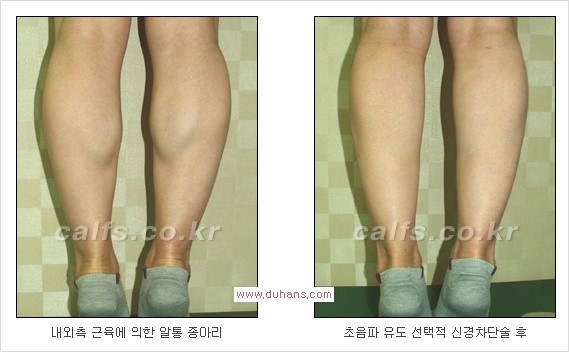 ⁠[두한성형외과 경쟁력 종아리성형] - [종아리퇴축술 - 비절개 초음파 유도 선택적 신경차단술 장비 안내] 관련 이미지 9