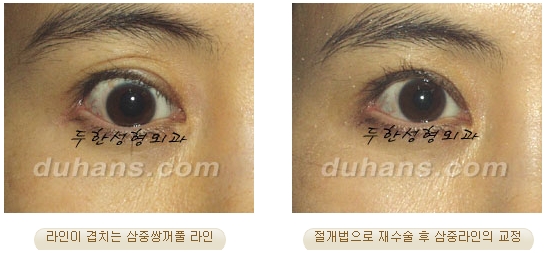 [두한성형외과 쌍커풀재수술] - [쌍커풀재수술 수술방법과 쌍커풀재수술 성공요건] 관련 이미지 30