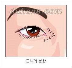 [두한성형외과 경쟁력 눈성형] - [흉터없는 몽고주름 제거술(앞트임) 관련 이미지 11