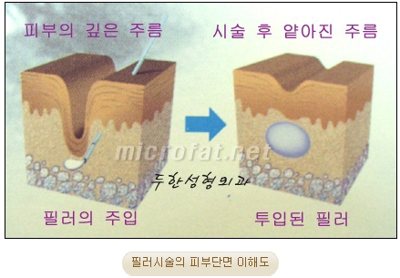 [Duhan Plastic Surgery Wrinkle Improvement] - [Wrinkle Filler Procedure] image 2