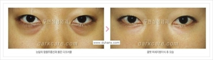 [두한성형외과 경쟁력 눈밑성형] - [눈밑 다크써클 증상과 그 증상에 맞는 치료 방법 안내] 관련 이미지 13