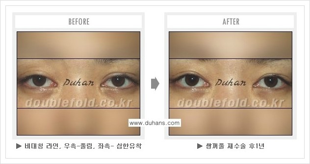 [두한성형외과 경쟁력 쌍꺼풀 재수술, 극한 재수술] - [쌍꺼풀 재수술로 인해 흉살이 두터운 경우] 관련 이미지 7