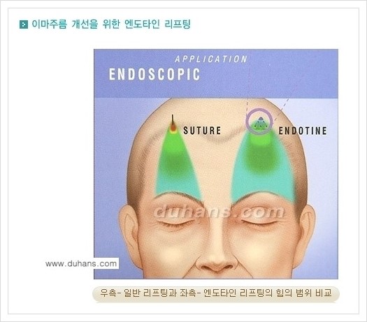 [두한성형외과 경쟁력 주름성형] - [엔도타인 리프팅 안내 ②] 관련 이미지 5