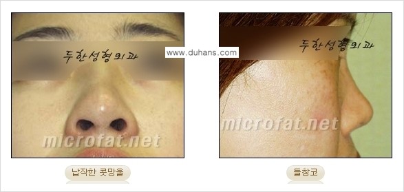 [두한성형외과 경쟁력 코성형] - [미세지방이식을 이용한 자연스러운 코성형 안내] 관련 이미지 2