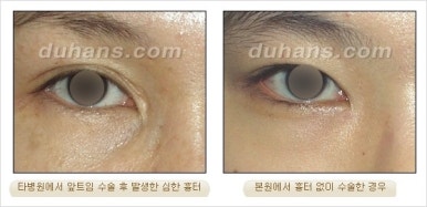 쌍커풀수술 두한성형외과 - 나에게 맞는 눈성형은? 관련 이미지 50