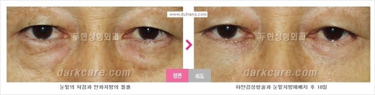 [두한성형외과 경쟁력 눈밑성형] - [눈밑 지방재배치의 문제점 안내] 관련 이미지 5