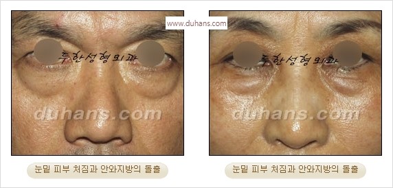 [두한성형외과 경쟁력 안검성형] - [젊어 보이면서 개선된 인상을 주기 위한 성형] 관련 이미지 2