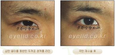 Duhan Plastic Surgery Ophthalmic Reoperation - What Is a Successful Double Eyelid Revision Surgery? image 22