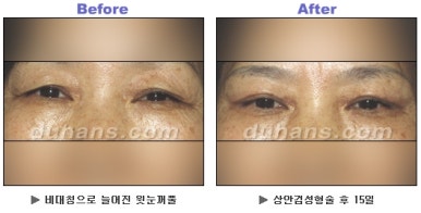 [Duhan Plastic Surgery Blepharoplasty] - [Upper Eyelid Surgery for a Younger-Looking Eye Area] image 8