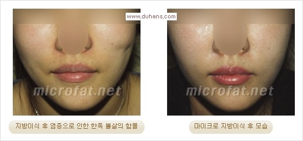 ​[두한성형외과 경쟁력 지방이식] - [지방이식 부작용 이후 마이크로 지방흡입, 마이크로 지방흡입 이후 부작용 없는 지방이식 방법] 관련 이미지 17