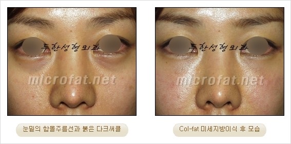​[두한성형외과 경쟁력 눈밑성형 리더] - [눈밑 다크써클의 증상, 원인, 종류, 치료방법 안내] 관련 이미지 37