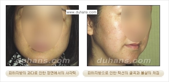 ​​​﻿[두한성형외과 경쟁력 간편지방흡입] - [볼살지방흡입, 턱선지방흡입 안내] 관련 이미지 3