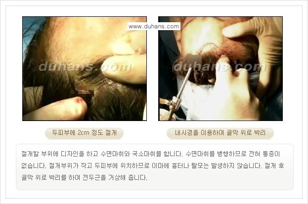 [두한성형외과 경쟁력 주름성형] - [엔도타인 리프팅 안내 ②] 관련 이미지 11
