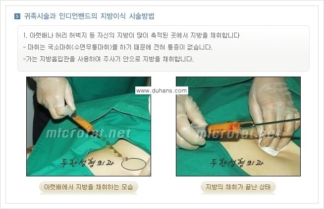 [두한성형외과 경쟁력 미세지방이식] - [귀족수술과 인디언밴드 교정 안내] 관련 이미지 2