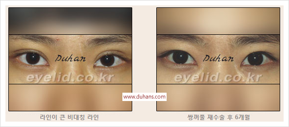 [두한성형외과 경쟁력 눈성형] - [절개법, 매몰법의 수술 방법] 관련 이미지 13