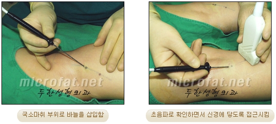 [Duhan Plastic Surgery Clinic Calf Contouring] - [Calf Reduction] image 10