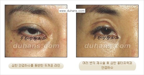 [두한성형외과 경쟁력 눈성형] - [두꺼운 라인을 교정하는 극한 눈 재수술 1.] 관련 이미지 3