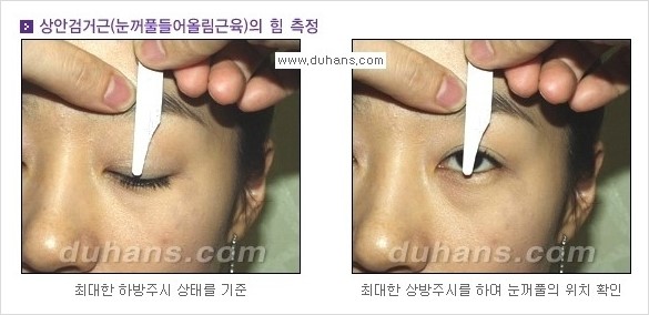 ​[두한성형외과 경쟁력 쌍꺼풀 재수술] - [아름다운 쌍꺼풀 선의 기준과 쌍꺼풀 재수술시 검사와 테스트 안내] 관련 이미지 9