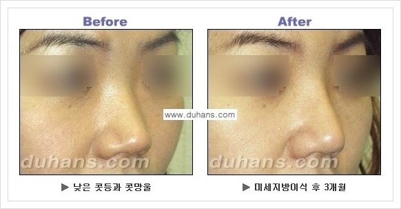 [두한성형외과 경쟁력 코성형] - [코높힘 미세지방이식 정보 안내] 관련 이미지 6