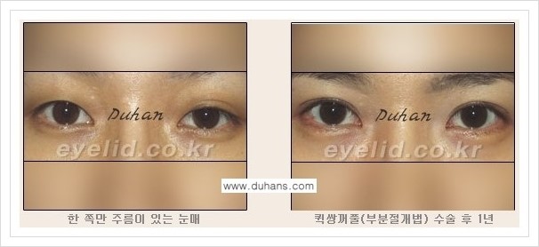 [두한성형외과 경쟁력 쌍꺼풀 재수술, 극한 재수술] - [쌍꺼풀 수술 관련 질문과 답변] 관련 이미지 5