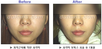 [Duhan Plastic Surgery Clinic Aesthetic Procedures] - [Square Jaw Botox] image 27