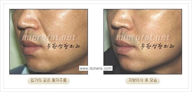 [두한성형외과 경쟁력 지방이식] - [입가주름, 팔자주름 미세지방이식의 안내] 관련 이미지 8