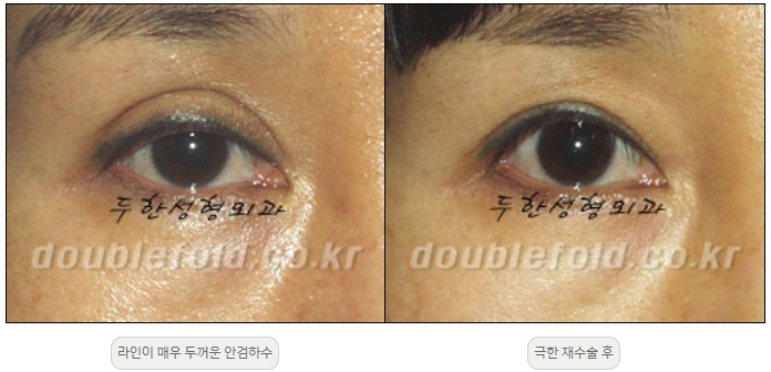 [Duhan Plastic Surgery Double Eyelid Revision] - [Thick Double Eyelid Line] image 56