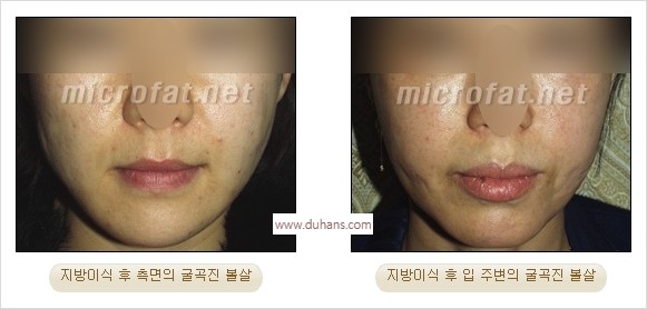 [두한성형외과 경쟁력 미세지방이식] - [타 병원의 지방이식 부작용 교정 - 정교한 마이크로 지방이식, 흡입 안내] 관련 이미지 10