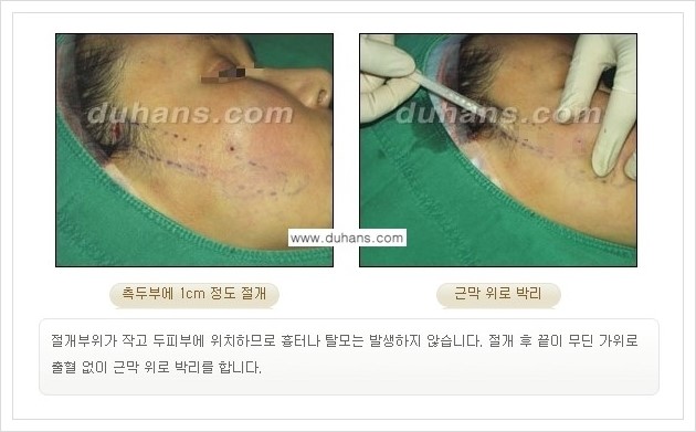 [두한성형외과 경쟁력 주름교정술] - [엔도타인 리프팅 안내 ②] 관련 이미지 5
