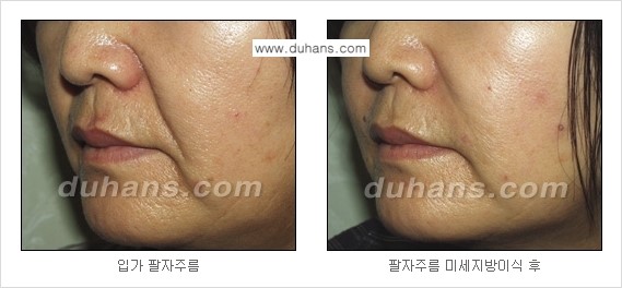 [두한성형외과 경쟁력 주름성형] - [미세지방이식을 이용한 주름교정 안내 - 눈밑주름, 입가주름, 팔자주름 2.] 관련 이미지 19