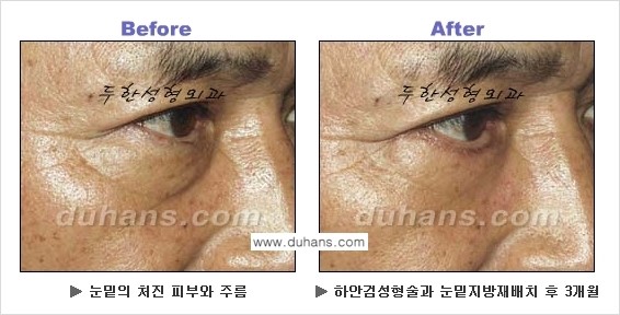 [두한성형외과의 상큼하고 환한 젊은 눈매완성] - [하안검 성형술 ②] 관련 이미지 13