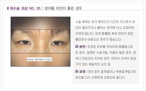 ⁠⁠[두한성형외과 경쟁력 쌍꺼풀 재수술, 극한 재수술] - [쌍꺼풀 재수술이 필요한 경우 안내] 관련 이미지 6