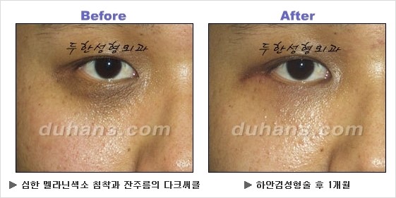 [두한성형외과 경쟁력 동안성형 리더] - ​[미간주름, 이마주름, 안검성형, 이마거상술, 눈썹거상술] 관련 이미지 107