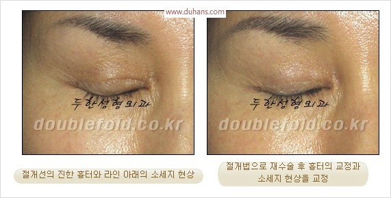 [두한성형외과 경쟁력 쌍꺼풀 재수술 리더] - [쌍꺼풀 흉터선, 쌍꺼풀 흉터 유착 교정술 안내] 관련 이미지 8