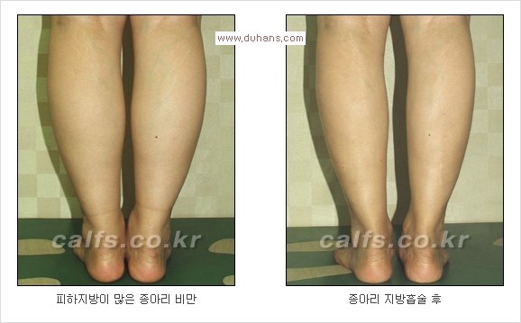 ⁠⁠[두한성형외과 경쟁력 멀티종아리성형] - [종아리성형 전후 주의해야 할 사항] 관련 이미지 6