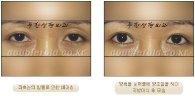 [두한성형외과 쌍커풀수술] - [쌍꺼풀지방이식] 관련 이미지 29