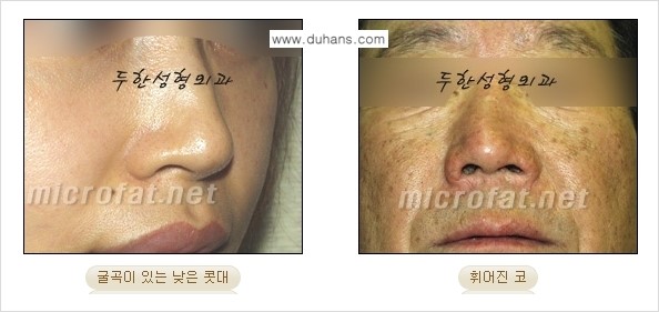 [두한성형외과의 No.1 경쟁력 미세(자가)지방이식] - [코높힘 미세(자가)지방이식 ①] 관련 이미지 4