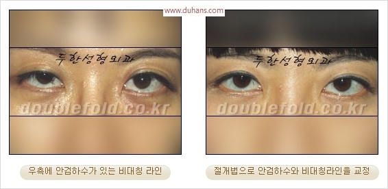 [두한성형외과 경쟁력 눈성형] - [극한 재수술, 함몰된 눈꺼풀 라인교정, 안검하수(졸리운 눈매)] 관련 이미지 101