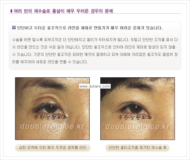 [두한성형외과 경쟁력 쌍꺼풀 재수술, 극한 재수술] - [재수술에서 극복해야 할 극한의 상황과 문제들 안내] 관련 이미지 3